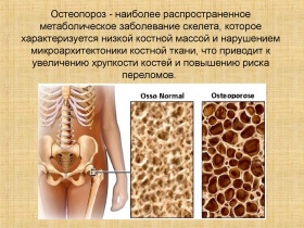 Новая услуга! Денситометрия - диагностика остеопороза!