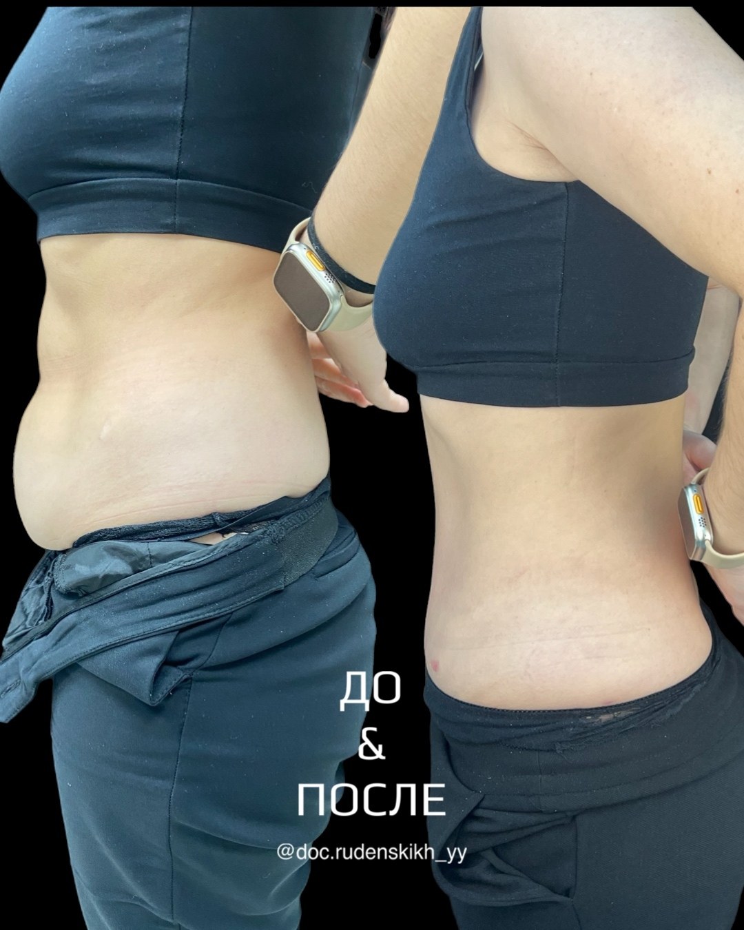 Абдоминопластика в клинике «Абсолютно Здоров» — профиль, до и после